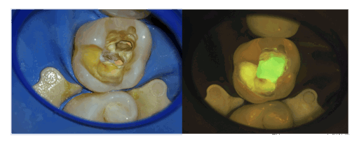 Flexioncam Treatment 1536X614